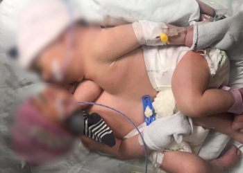 Siyam ikizi bebekler doğumdan 8 gün sonra ayrıldı