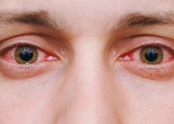 Pakistan’da ‘kırmızı göz’ salgını: Tablo giderek ağırlaşıyor